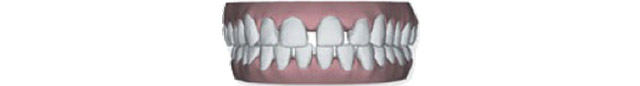 Ortodoncia Baracket metalicos