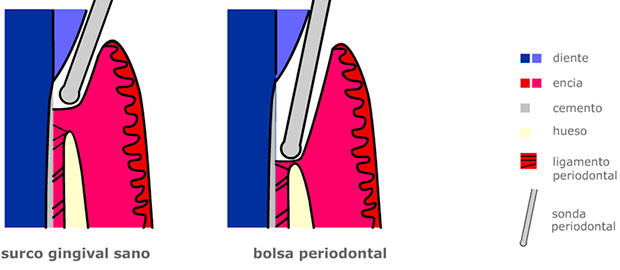 surco gingibal