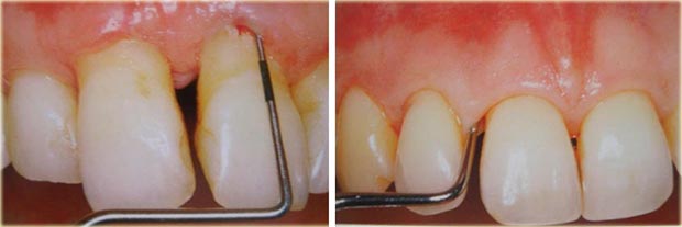 Anatomía del periodonto