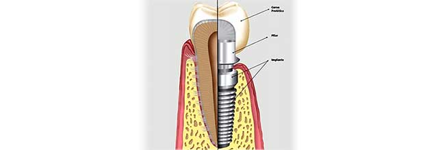 Implante Dental