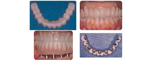 Implantes Dentales