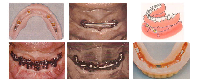 Implantes Dentales sobredentadura