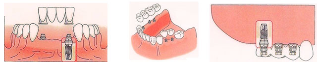 Implantes Dentales Parcialmente edentulos