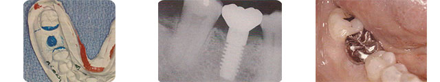 Implantes Dentales Parcialmente edentulos