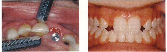 Implantes Dentales Parcialmente edentulos