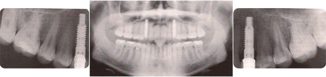 Implantes Dentales Parcialmente edentulos