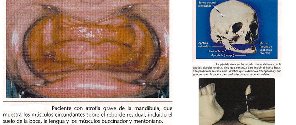 Implantes Dentales Perdida dental total