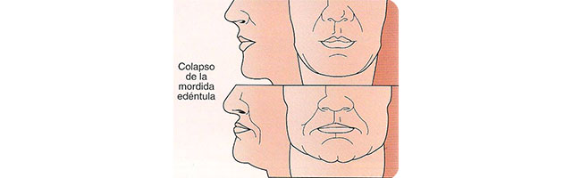 Implantes Dentales Colapso de la mordida edéntula