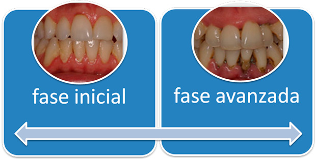 riesgos enfermedad dental